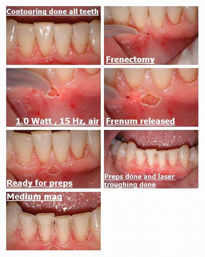 Resize of Lower Anterior pg 2.jpg